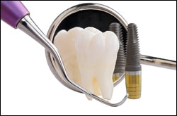 dental implants | dentist | fredericksburg