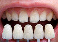 veneers