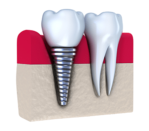 cosmetic-dental-implants implants