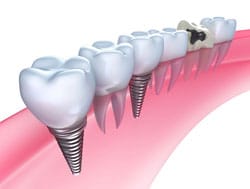 dental implants | dentist | fredericksburg