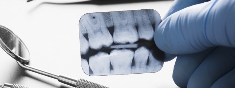 dentist | xray | digital x-rays | fredericksburg