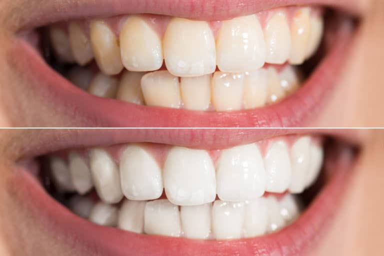 Person Teeth Before And After Whitening Fredericksburg Dental Center Person Teeth Before And After Whitening Fredericksburg Dental Center