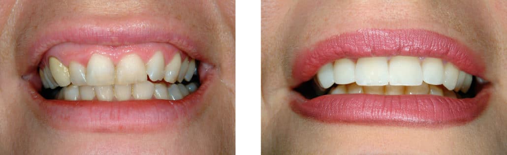 Before & After Veneers Photos